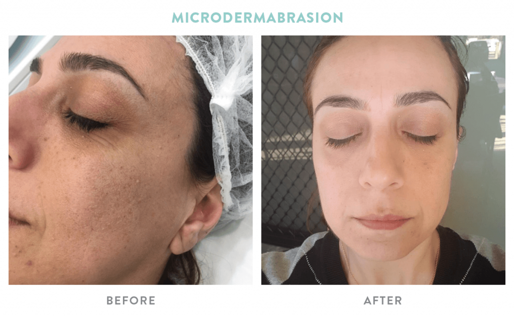 Everything You Need to Know About Microdermabrasion Treatment | Mouda Laser & Skin Clinic